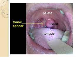 If not, how and when will you find out the stage of the cancer? Throat Cancer Stage 1 Celine Dion Songs Age