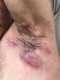 ter bezi iltihabi nedenleri belirtileri tedavisi herbalist erdogan tepeli