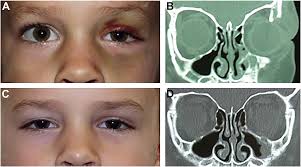 Pediatric Orbital Fractures