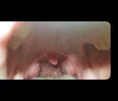 Bei einer angina ist immer ein arzt aufzusuchen, um die ursache und die jeweilige behandlungsmöglichkeit herauszufinden und bei komplikationen schnellstmöglich handeln zu können. Ist Es Eine Rachenentzundung Bild Gesundheit Und Medizin Gesundheit Arzt
