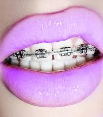 Pin By Carolann Crucitt On Braces Lip Art Cute Braces Pink Lips
