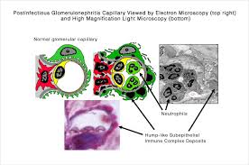 Electron microscopy and immunoelectromicroscopy protocols. Post Infectious Glomerulonephritis Gn Unc Kidney Center