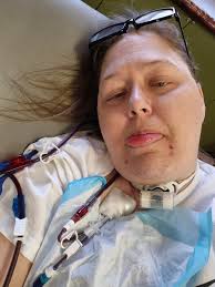 Has anyone gone from PD to hemodialysis? If so what did you do all the  supplies?