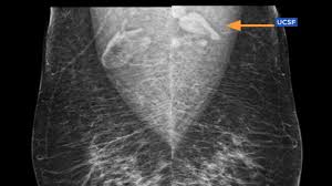 Cancers that do not express er or pr are hormone receptor negative and need to be treated with chemotherapy unless the cancer is very small. Swollen Lymph Nodes Doctors Explain The Covid Vaccine Side Effect That S Being Mistaken For Breast Cancer Abc7 Chicago