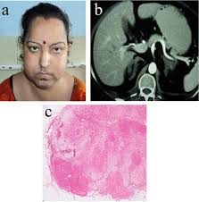 Biochemically, ppnad is characterized by elevated levels of plasma and urinary cortisol that are not suppressed by high doses of dexamethasone (8mg/d for 2 days). Primary Bilateral Adrenal Nodular Disease With Cushing S Syndrome Varying Aetiology Abstract Europe Pmc
