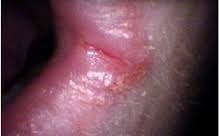 Check out our video library. Plummer Vinson Syndrome Wikipedia