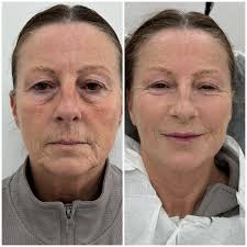 Signature Liquid Lift. It's all the little things✨✨✨✨✨ THAT MAKE THE  BIGGEST DIFFERENCE… 💥 Small changes. BIG RESULTS. Liquid Face Lift Points.  Brow bone. Temple hollows. UnderEyes. Cheekbones. Cheek fat pads. Alar