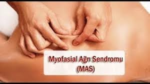 Miyofasiyal ağrı sendromunun (mas) alnda yatan periferik ve merkezi nöral mekanizmalarının. Myofasial Agri Sendromu Youtube