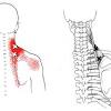 Anatomy of neck muscles diagram. 1