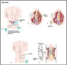Spinal Fusion Procedure Test Blood Tube Removal Pain Time Infection