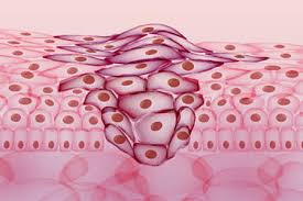 There's not enough information to determine the stage. What Options Are Available When Melanoma Spreads To The Brain