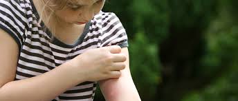Diagnosis is typically suspected based on history and physical signs, but confirmation is rare because. Seven Bug Bites You Should Never Ever Ignore