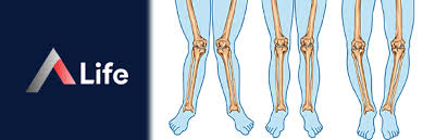 Image result for Genu Varum