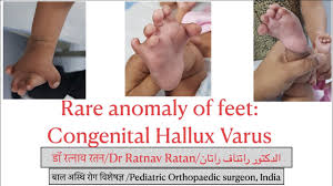 Image result for Hallux Varus