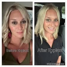 Hi ladies, I have started to share exercises that I do... this is my  journey and just putting out there we ALL heal differently and active  levels are different. I have also