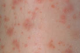 The red spot may be, bumpy, itchy, or otherwise irritated rash. Derm Dx Small Red Spots On The Lower Extremities With Knee Pain Clinical Advisor
