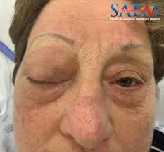 Image result for Proptosis