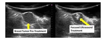 While it may look like a fuzzy, spotty television screen with different shades of grey to a. Price Lab Focused Ultrasound For Breast Cancer Drug Delivery And Immunotherapy