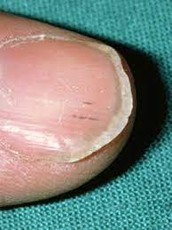 What Are The White Spots On Your Nails Trying To Tell You Everyday Health Black Lines Under Nails Toe Nail Discoloration Lines On Nails