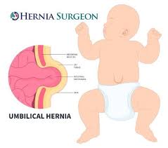 Image result for Inguinal hernia child