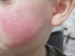 Image result for red rash face