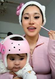 Understanding Torticollis and Helmet Therapy for Infants