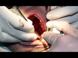 We did not find results for: Root Canal Surgery Youtube