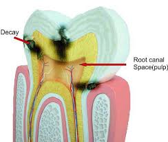 Knowing what to eat after a root canal or similar dental procedure can help make your recovery process far easier than it would be if you just ate whatever you felt like eating. Root Canal Treatment Procedure Risk And Benefit Sanjivani