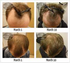 How Do I Know If My Hair Loss Is Due To Male Pattern Baldness?