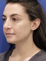 Earlobe Reduction 6705