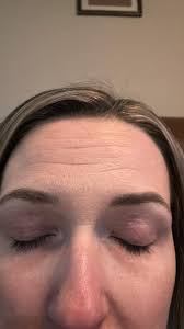 Tallow for Eczema and Dry Skin Relief