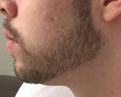 Sie sind zeichen einer immunreaktion des körpers und deshalb unbedenklich. Kann Ich Den Bart So Lassen Bartwuchs