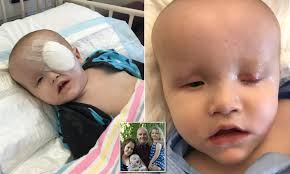 Baby boy born without eyes undergoes operation and is set to get a  prosthetic eye
