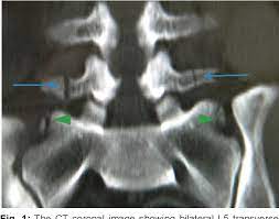 Maybe you would like to learn more about one of these? Bilateral L5 Transverse Process Fracture Implications What Every Spine Surgeon Must Know Semantic Scholar