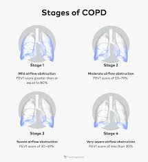 Image result for COPD Staging