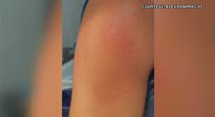 Doctors warn of delayed side effects from moderna vaccine. Covid Arm Moderna Side Effect No Cause For Alarm