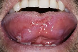 Image result for mouth ulcer on tongue)