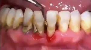 Limpeza E Raspagem Dos Dentes Pelo Dentista Remocao De Calculo Dental Video Tartaro Dentario Higiene Dental Remocao De Tartaro