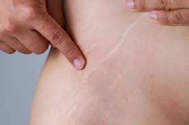 Artikel ini tentang cara hilangkan stretch mark atau perut berakar untuk ibu lepas bersalin agar kulit menjadi lebih cantik dan licin berseri. Begini Cara Menghilangkan Stretch Mark Yang Efektif Jovee Id