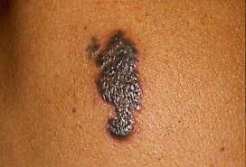 Tattoo infections aren't likely if you take care of the area after you get inked. What To Do When Tattoos Go Bad