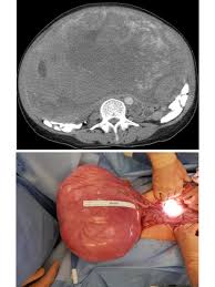 Image result for Leiomyosarcoma