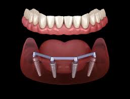 Before and After - All On 4 Dental Implants