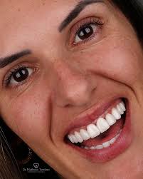 A transformação de hoje ✨FALA POR SI!✨ Facetas em resina estratificadas,  planejadas detalhe por detalhe, respeitando forma, cor e naturalidade.  Quando técnica, olhar clínico e bom senso se encontram, o resultado é
