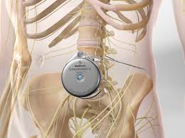 Image result for Intrathecal Pump