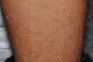 Transfascial Muscular Hernia An Unusual Cause For A Hide And Seek Subcutaneous Nodule