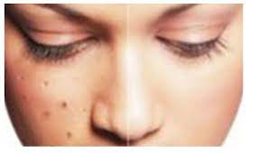 7 cara menghilangkan bintik hitam dengan butiran scrub. Guna 2 Bahan Untuk Hilangkan Bintik Hitam Di Muka