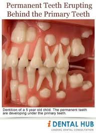 Appearance Of Shark Teeth In Infants Is Quite Common And Is Seen At An Age Group Of 6 7 Years When Permanent Lower Incisors Eru Dental Anatomy Dental Dentistry
