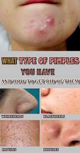 What Type Of Pimples You Have And How To Get Rid Of Them Painful Pimple Acne On Nose Pimples Under The Skin