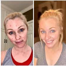 Dark Spots? Pigmentation? Not Anymore! Try This Magic Night Cloves Oil 👇💬