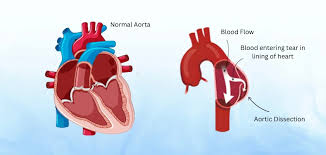 Image result for Aortic Dissection
